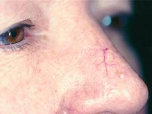 laserové odstránenie ciev na tvári