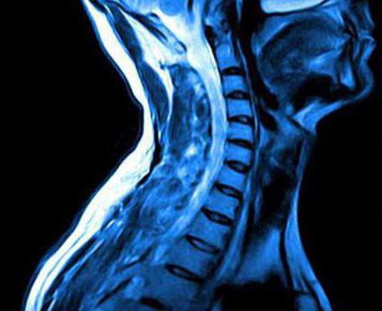 Interpretácia spinálnej MRI